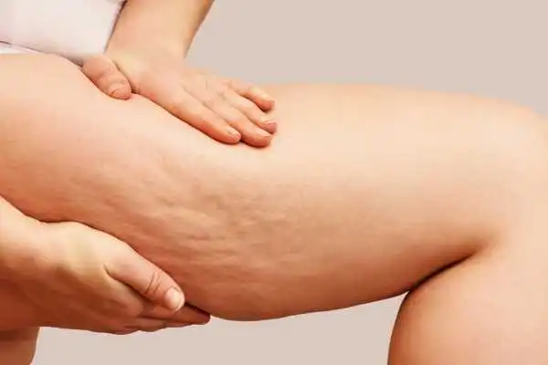 Image of woman showing leg with cellulite Accrington