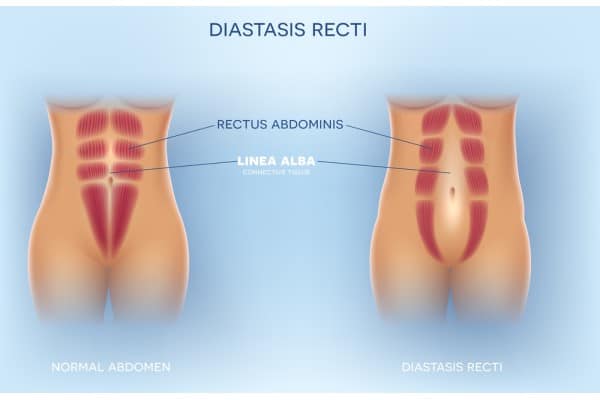 What Non-Surgical Options Are Available for Diastasis Recti Accrington?