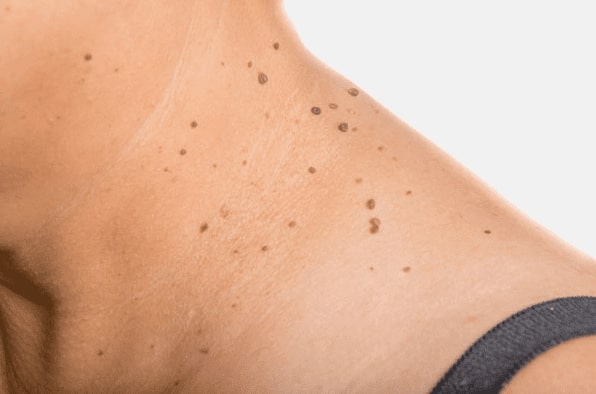 Are you looking for easy skin tag removal Accrington - then contact Spire today!
