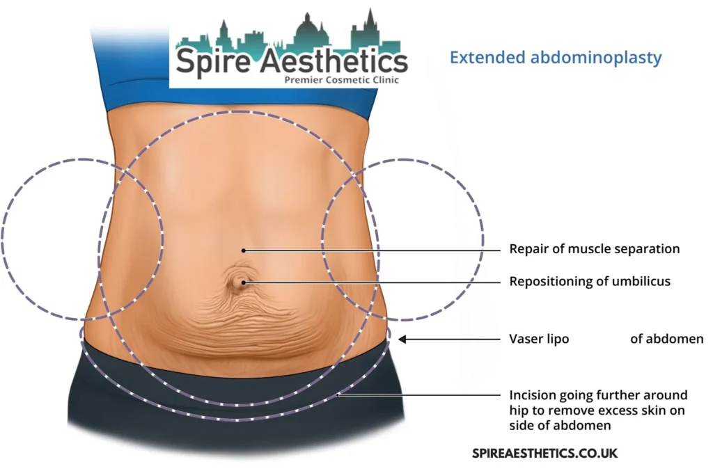 Understanding Loose Skin After Gastric Band Accrington Surgery and HIFU Treatment