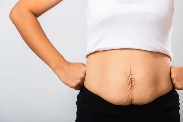 Image of a woman's stomach after weight loss with sagging skin following a gastric band Accrington