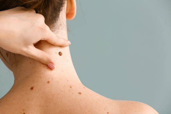 skin blemish removal Accrington treatment
